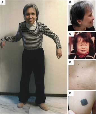 Long-term clinical course of adult-onset refractory epilepsy in cardiofaciocutaneous syndrome with a pathogenic MAP2K1 variant: a case report